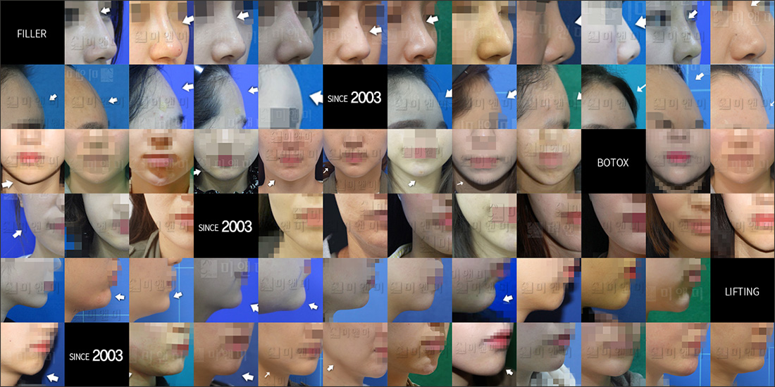 SINCE 2003 MI&MI, 시술후사진모음 분당코필러, 서현역코필러