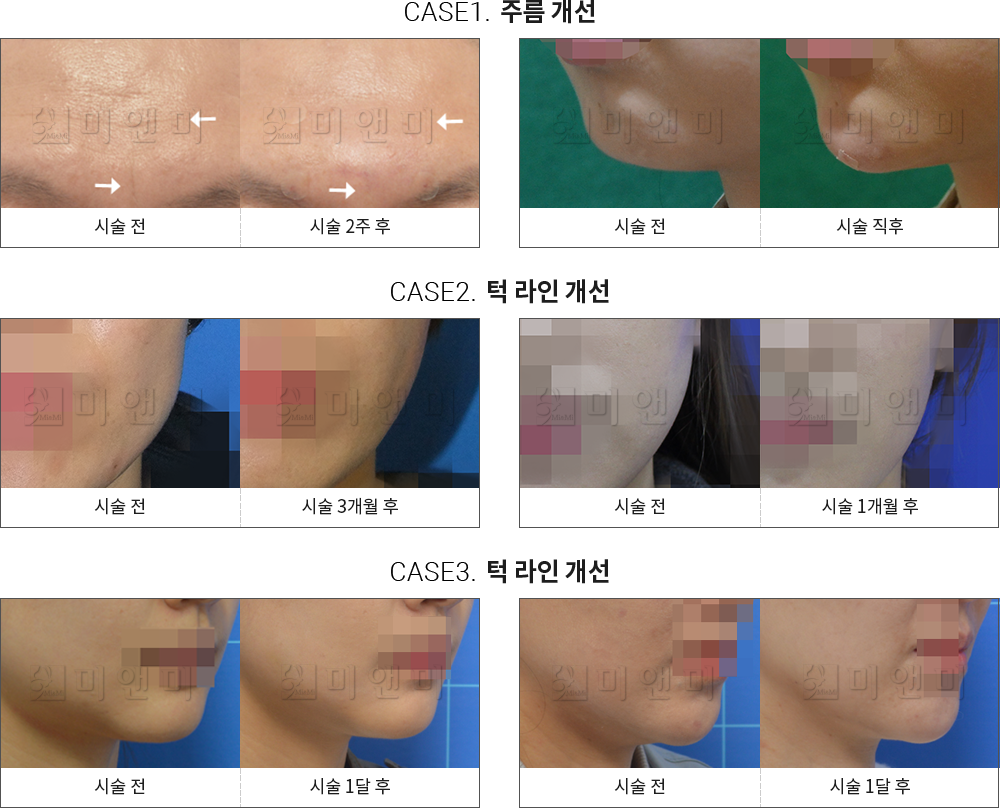 시술전후사진 주름 보톡스 : 주름 개선, 턱 라인 개선 분당더모톡신,서현역더모톡신,분당보톡스,서현역보톡스,분당사각턱보톡스,서현역사각턱보톡스,분당턱보톡스,서현역턱보톡스,분당주름보톡스,서현역주름보톡스,분당승모근보톡스,서현역승모근보톡스,분당V라인주사,서현역V라인주사,분당액취증,서현역액취증,분당다한증,서현역다한증