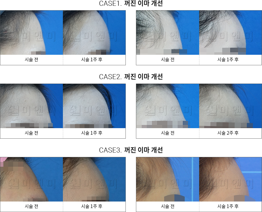 시술전후사진 이마필러 : 무턱개선 분당이마필러, 서현역이마필러, 분당필러, 서현역필러, 분당코필러, 서현역코필러, 분당무턱필러, 서현역무턱필러, 분당볼필러, 서현역볼필러, 분당얼굴필러, 서현역얼굴필러, 분당주름필러, 서현역주름필러, 분당애교필러, 서현역애교필러,분당팔자주름필러, 서현역팔자주름필러, 분당입술필러, 서현역입술필러