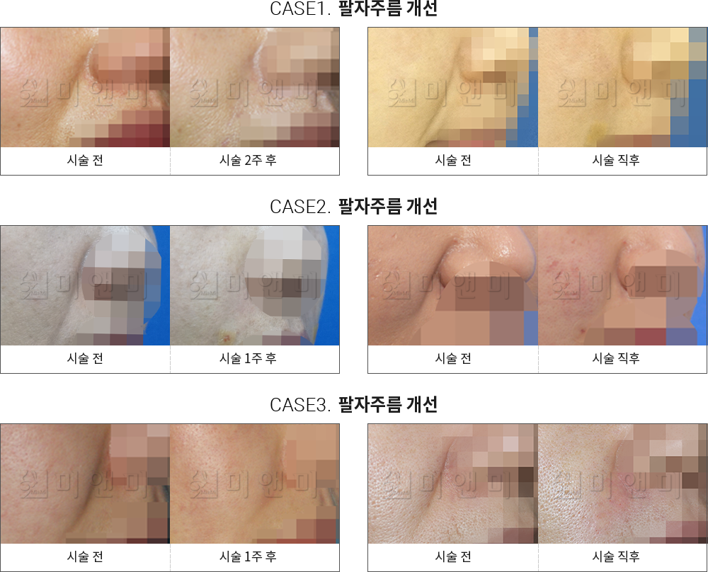 시술전후사진 팔자필러 : 팔자주름 개선 분당팔자필러,서현역팔자필러