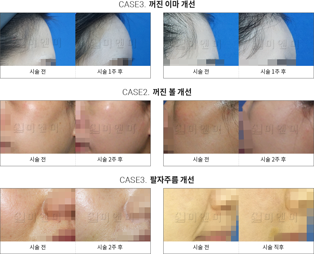 시술전후사진 엘라쎄 : 꺼진 이마 개선,꺼진 볼 개선,팔자주름 개선 분당피부과-서현역피부과 아름다움을 피우다 분당피부과 미앤미